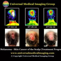 Treatment Progress of Melanoma - Reversing Skin Cancer of the Scalp