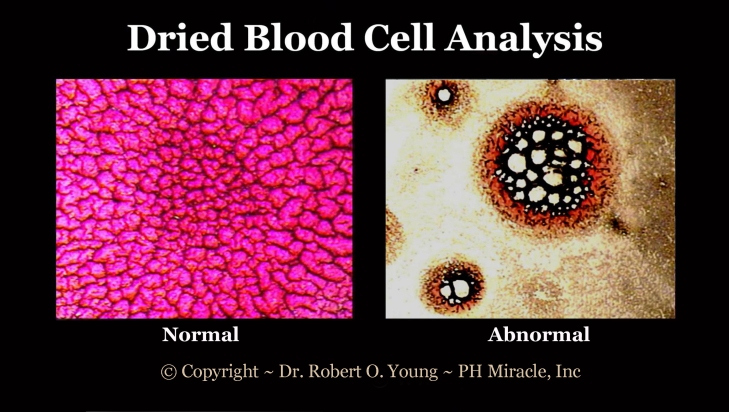 Live and Dried Blod Analysis - Copyright - ROY